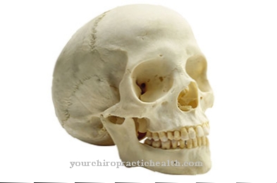 Craniostenosis