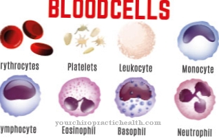 Spheroidal cell anemia