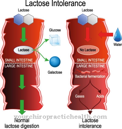 Intoleransi laktosa (intoleransi gula susu)