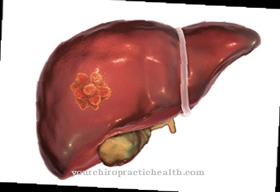 Diseases - Liver cancer (liver cancer)