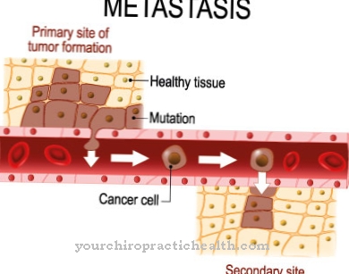 Liver metastases