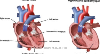 hipertenzija, hipertrofija lijeve klijetke srca
