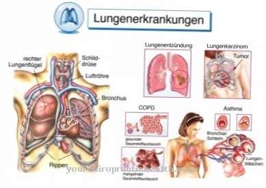 Lung abscess