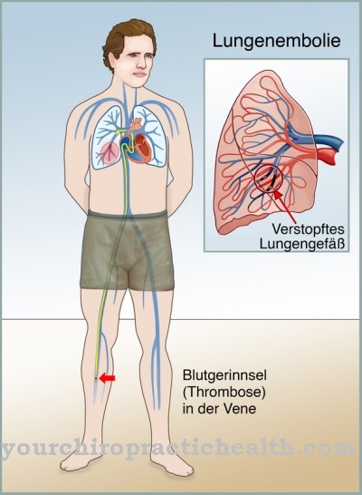 Embolisme pulmonari