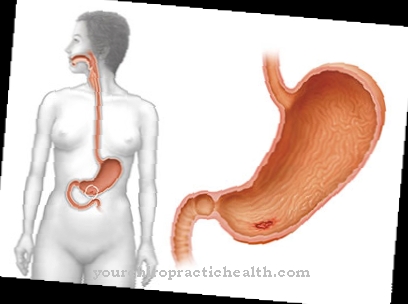 Gastric ulcer