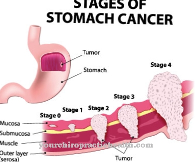 Рак на стомаха