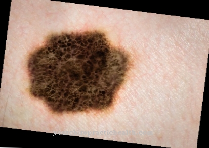 Melanoma (black skin cancer)