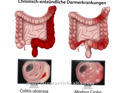 Crohnova bolezen (kronično vnetje črevesja)