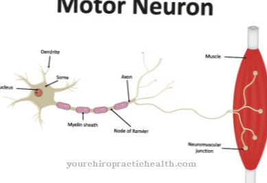 Neuropathie motrice multifocale