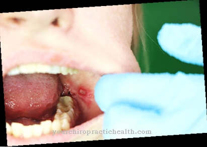 Inflammation of the oral mucosa