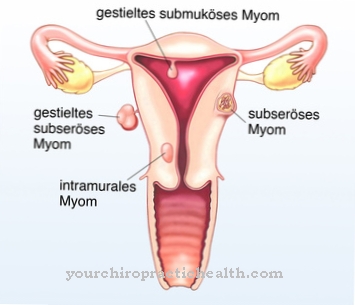 Fibroid (tumoră uterină)