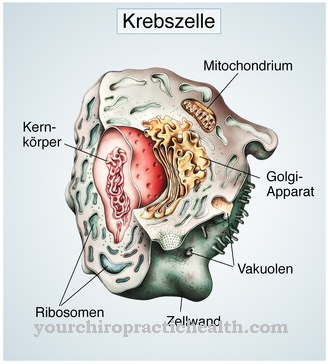 Neuroblastome