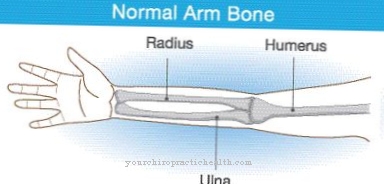 Upper arm fracture