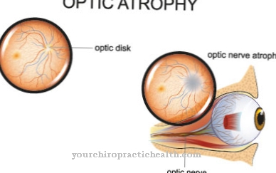 Optic atrophy