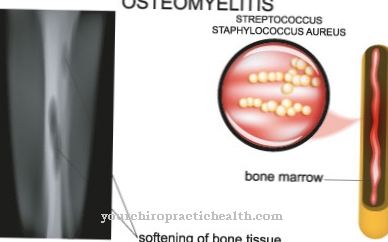 Osteomyelitis (inflammation of the bone marrow)