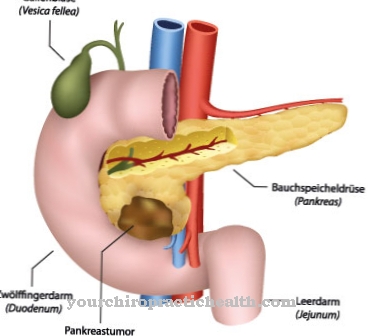 Pancreatic tumor