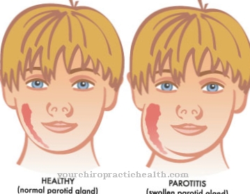 रोग - parotitis