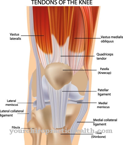 Patellar tendon rupture