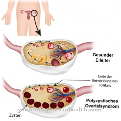 Polycystic ovarian syndrome (polycystic ovary syndrome)