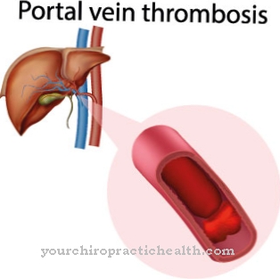 Portal vein thrombosis