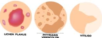 Pityriasis versicolor (leseiden sieni)