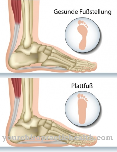 Flat foot