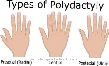 Polydactylie