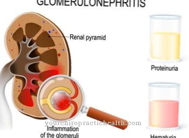 Post-infektiøs glomerulonephritis