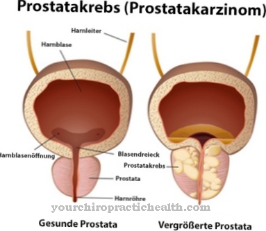 Рак на простатата (рак на простатата)