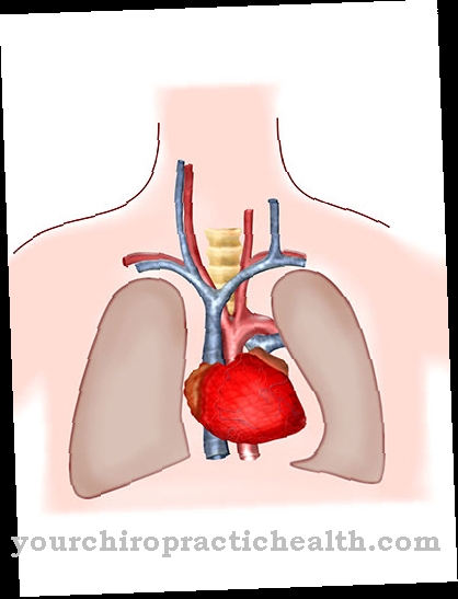 Pulmonary hypertension