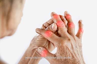 Reaktivni artritis