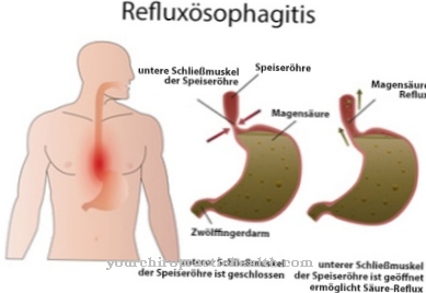 Reflux esophagitis