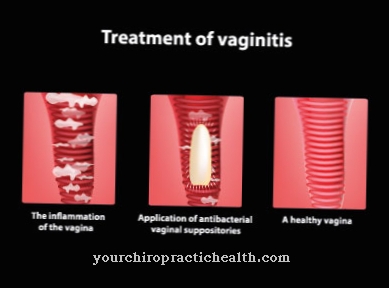 Vnetje nožnice (vaginitis)