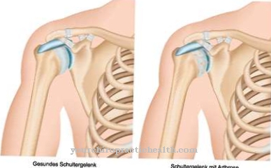 Osteoarthritis of the shoulder (omarthrosis)