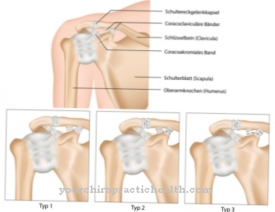 Shoulder dislocation
