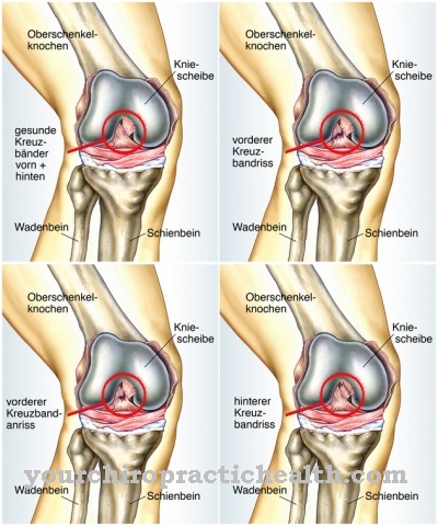 Lacerazione del legamento collaterale sul ginocchio
