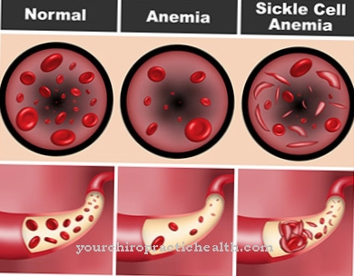Сърповидно-клетъчна анемия