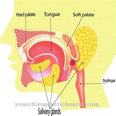 Inflammation of the salivary glands (salivary stone)