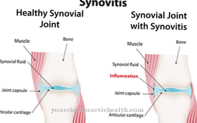 Synovitis