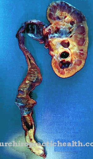 Ureteral carcinoma
