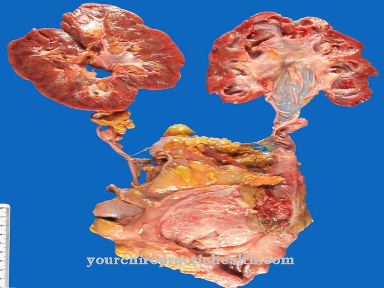 Carcinoma urotelial