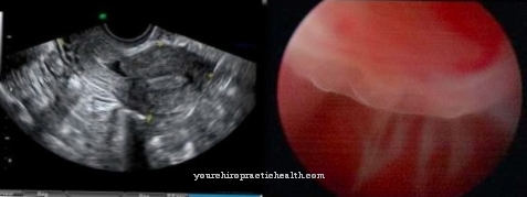 Ruptura maternice (zlom maternice)