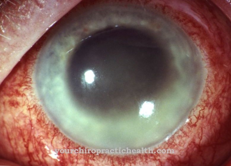 Uveitis (inflammation of the skin of the blood vessels)