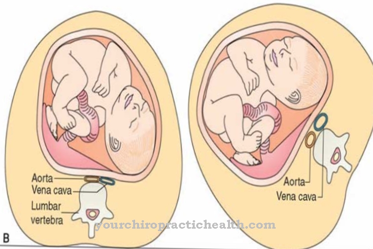 Sindrom mampatan vena cava