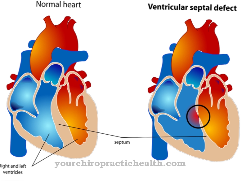 Défaut septal ventriculaire