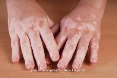 Vitiligo (white spot disease)
