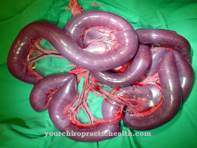 Volvulus (črevesna obstrukcija)