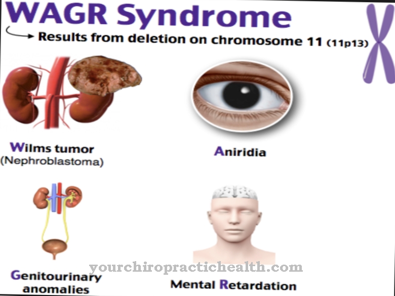 WAGR sindrom