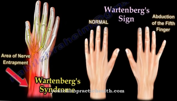 Wartenbergov sindrom