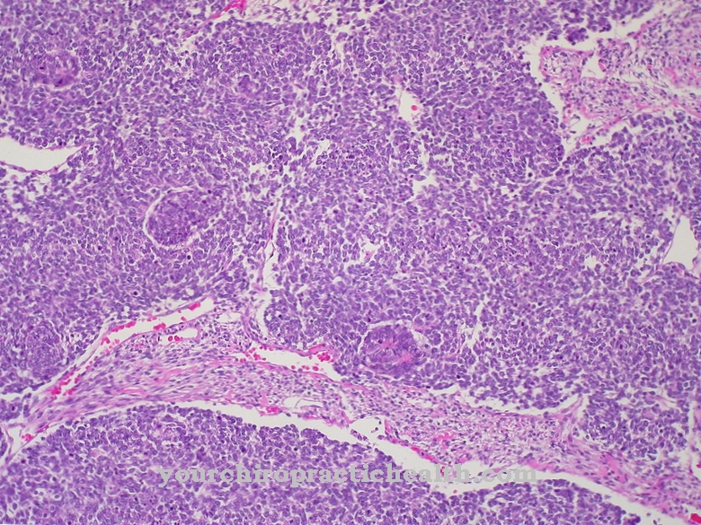 Tumor de Wilms (nefroblastoma)